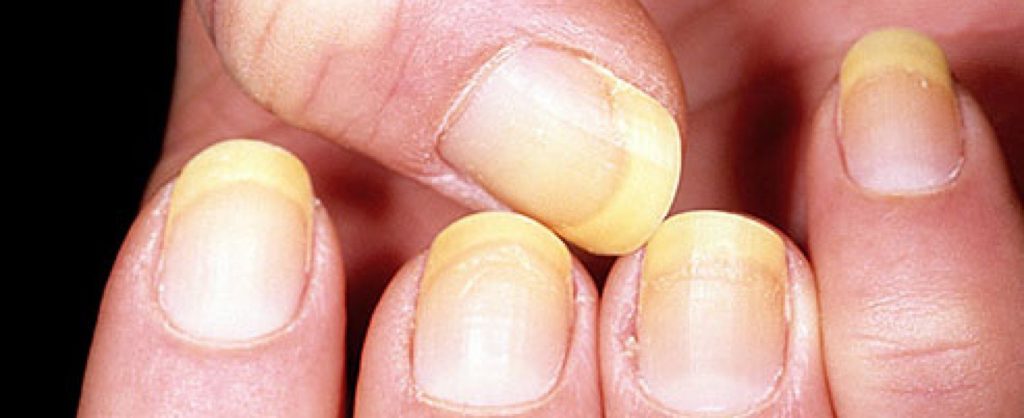  5 причин, по которым ногти могут стать желтого оттенка.