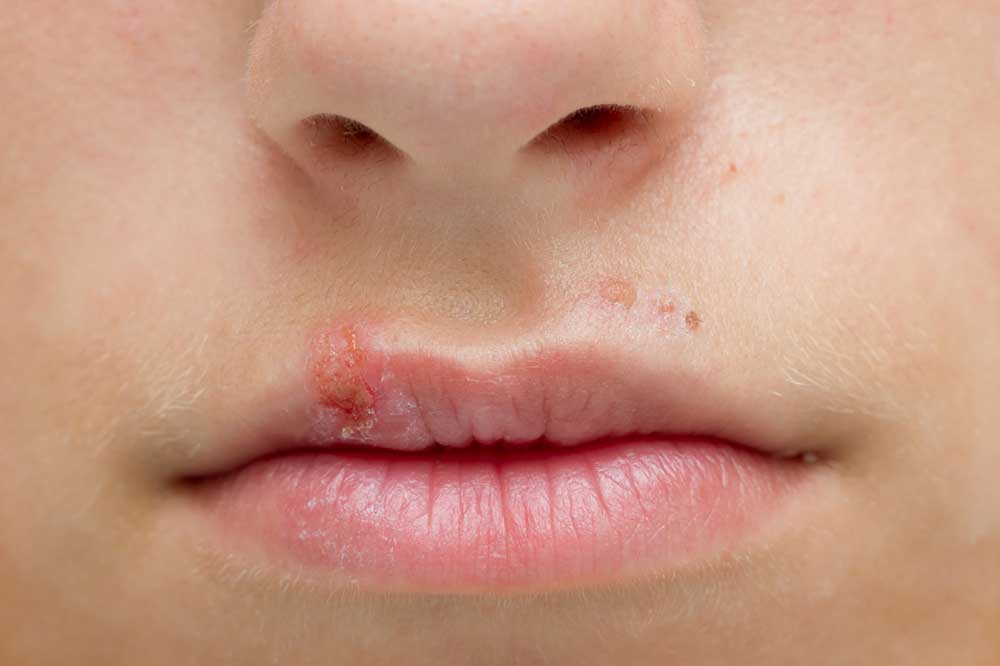 Лечение герпеса на губах: 5 народных рецептов