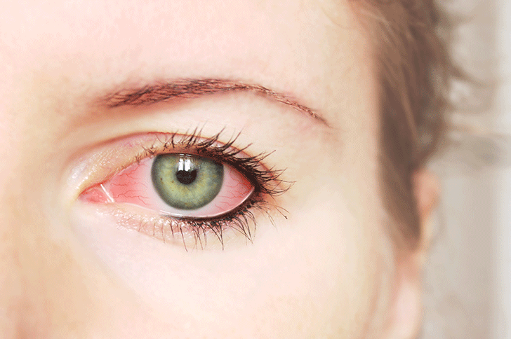 Причины и способы лечения покраснения глаз