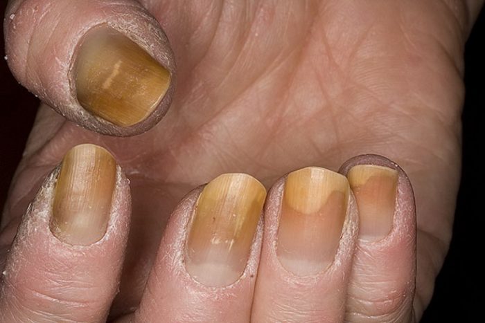 Как отбелить пожелтевшие ногти?