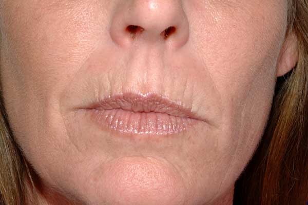 Как просто устранить провисания кожи вокруг рта?